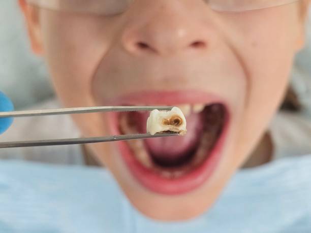 Best Urgent Tooth Repair  in Surgoinsville, TN